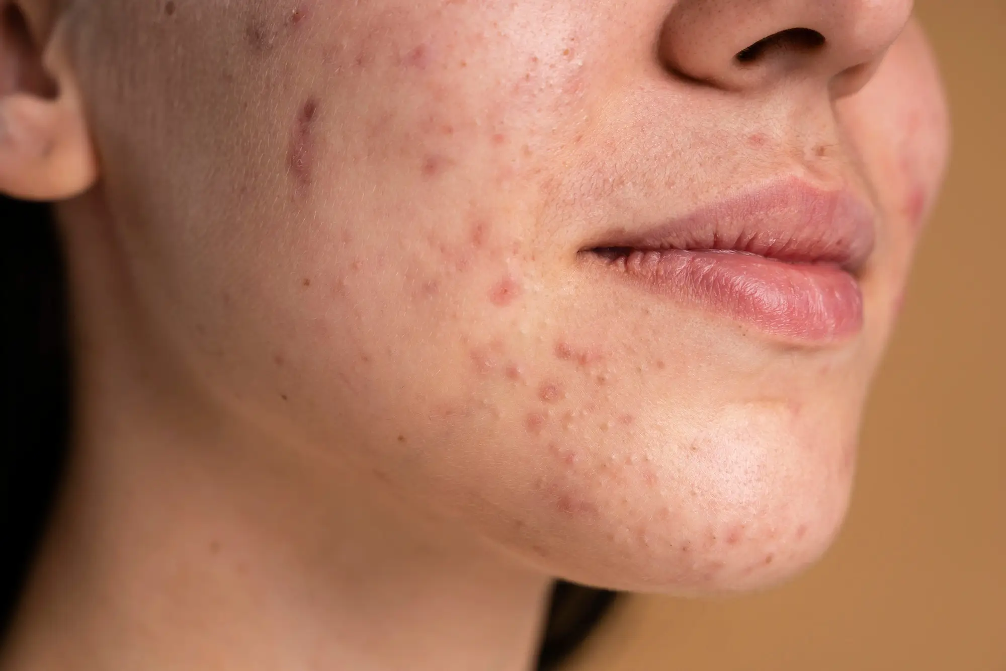 acne treatment Warrenton VA