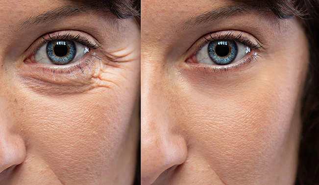 prp filler before and after