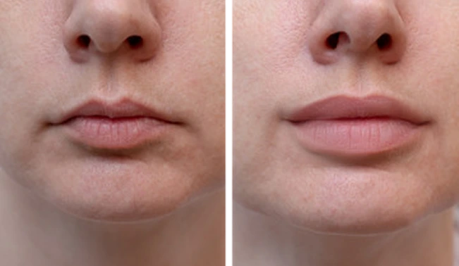 prp filler before and after