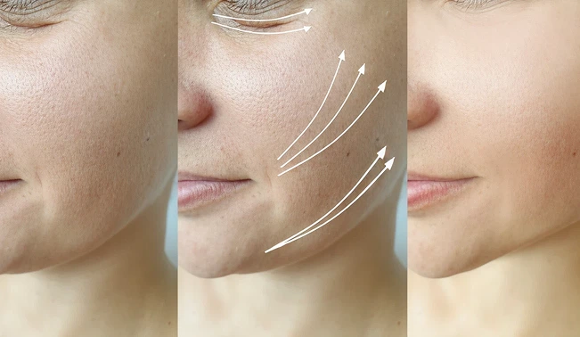 prp filler before and after